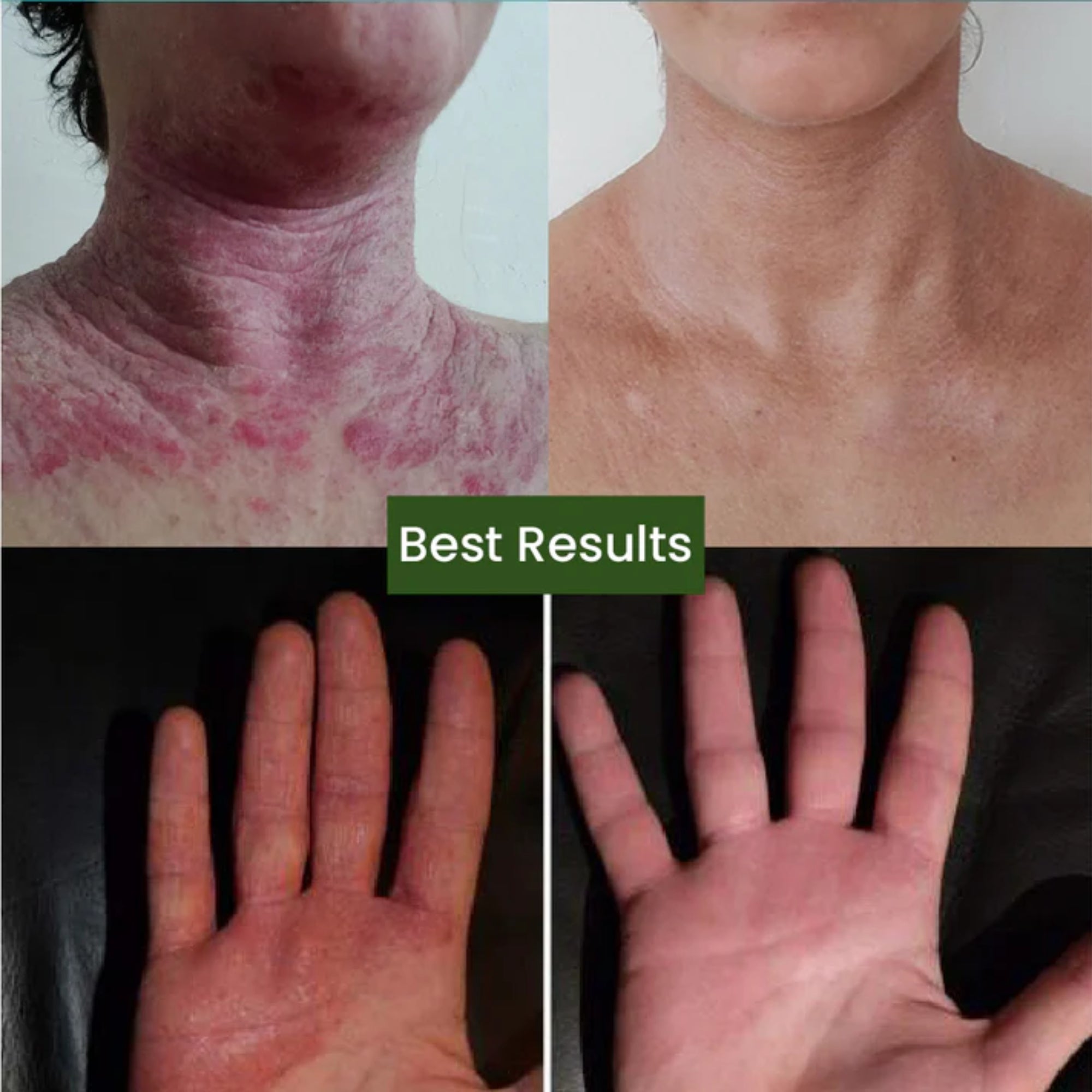 Cipzer Eczema Total Skin Capsules