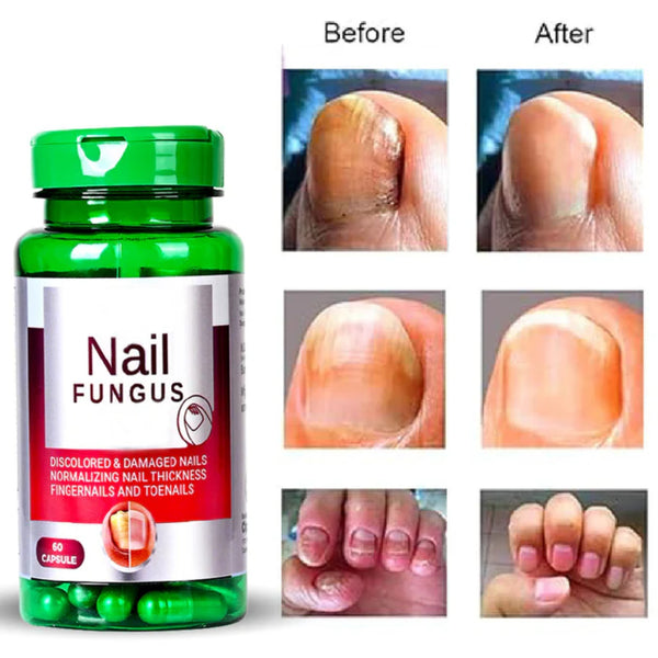 Cipzer Nail Fungus Capsules