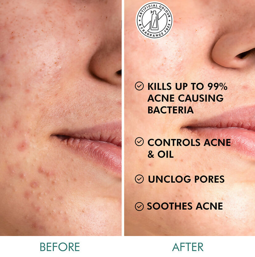 mCaffeine 2% Salicylic Acid Serum Clear Skin Acne Pads - Acne & Oil Control with Matcha Tea - Distacart