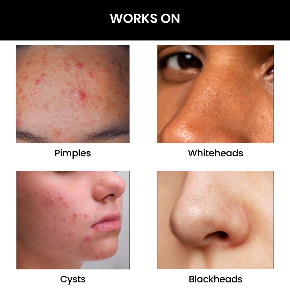 ThriveCo Goodbye Acne Serum - Distacart