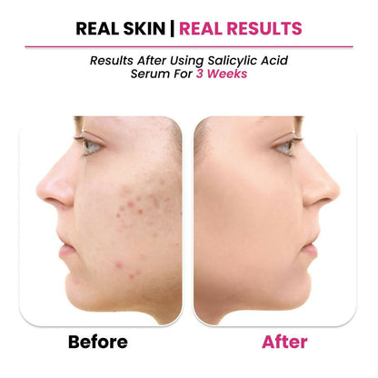 ThriveCo 2% Salicylic acid Serum - Distacart