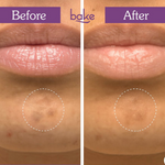 Thumbnail for Bake Spot Erase Micropoint Hydrocolloid Patches for Dark Spots