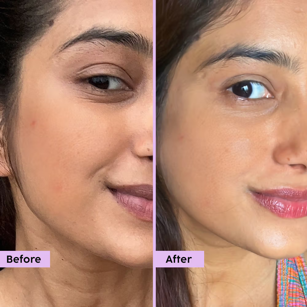 PLIX The Plant Fix - Jamun Active Acne Regime With Cleanser & Toner To Unclog Pores & Reduce Acne - Distacart