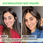 Thumbnail for PLIX The Plant Fix 2% Salicylic Acid Active Acne Control Serum & Acne Buster Moisturizer Combo - Distacart
