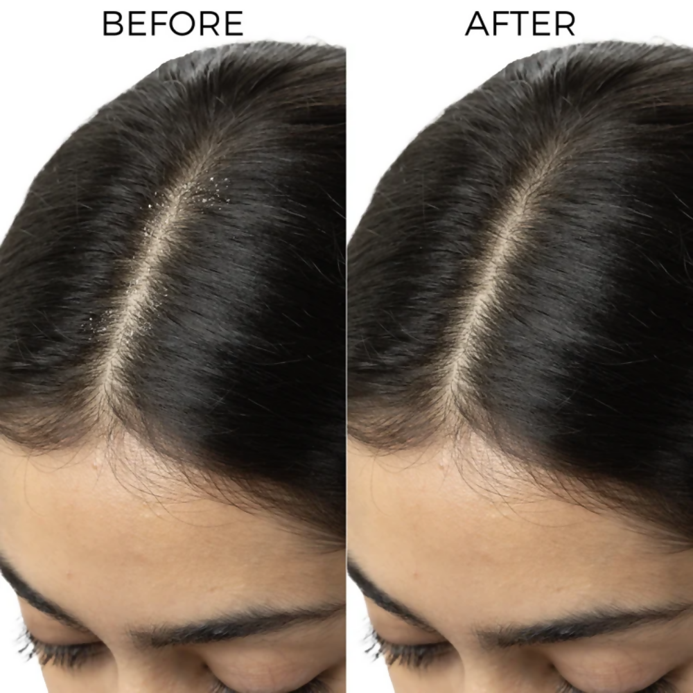 Brillare Dandruff Control Kit - Dista
