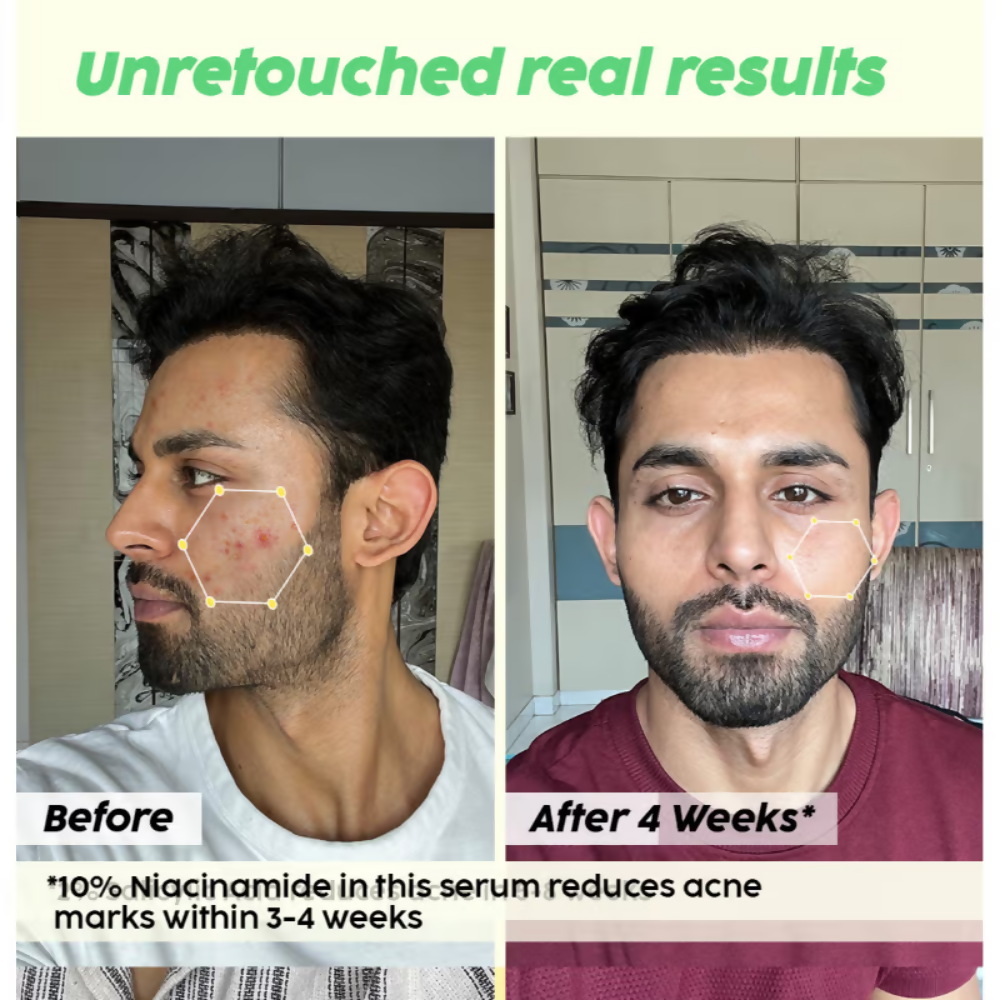 PLIX The Plant Fix 2% Acne Buster Moisturizer & 10% Niacinamide Serum - Distacart