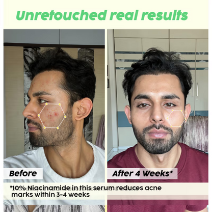 PLIX The Plant Fix 2% Acne Buster Moisturizer & 10% Niacinamide Serum - Distacart