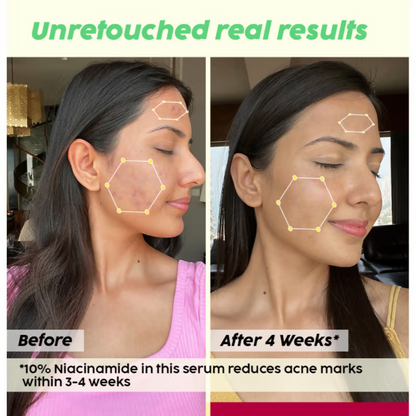 PLIX The Plant Fix 2% Acne Buster Moisturizer & 10% Niacinamide Serum - Distacart