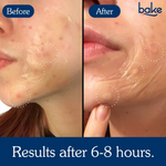 Thumbnail for Bake Acne Erase XL Pimple Patches & Nose Patches