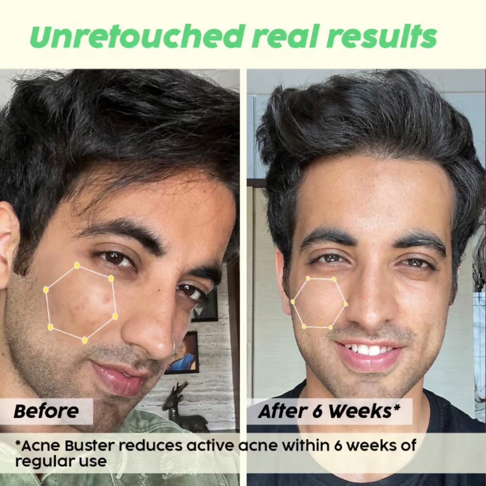 PLIX The Plant Fix 2% Salicylic Acid Active Acne Control Serum & Acne Buster Moisturizer Combo - Distacart