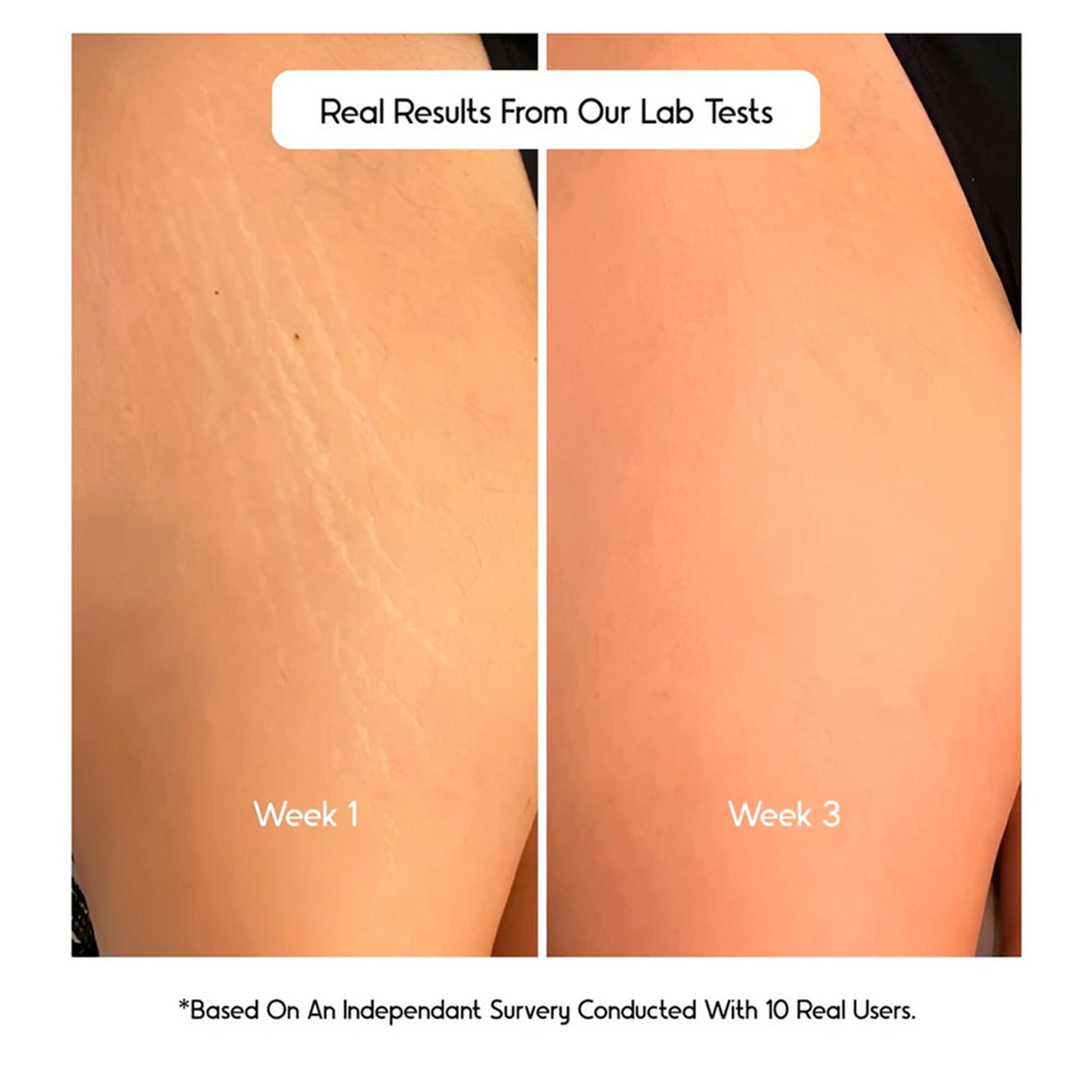 Cos-IQ Stretch Marks Removal Roll-On Serum with Striover - Distacart