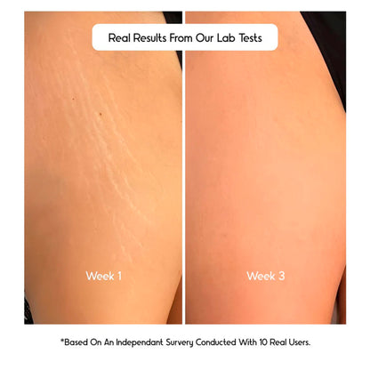Cos-IQ Stretch Marks Removal Roll-On Serum with Striover - Distacart