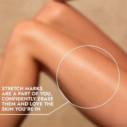 Cos-IQ Stretch Marks Removal Roll-On Serum with Striover - Distacart