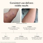 Thumbnail for Vedicderm Psoriasis Cream with 2% Bakuchi Extract - Distacart