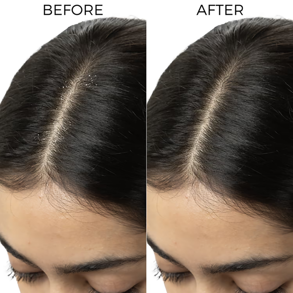 Brillare Tea Tree & Salicylic Oil Shots For Dandruff Control - Dista