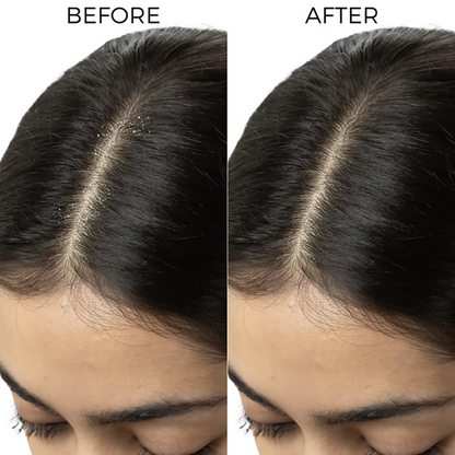 Brillare Tea Tree & Salicylic Oil Shots For Dandruff Control - Dista