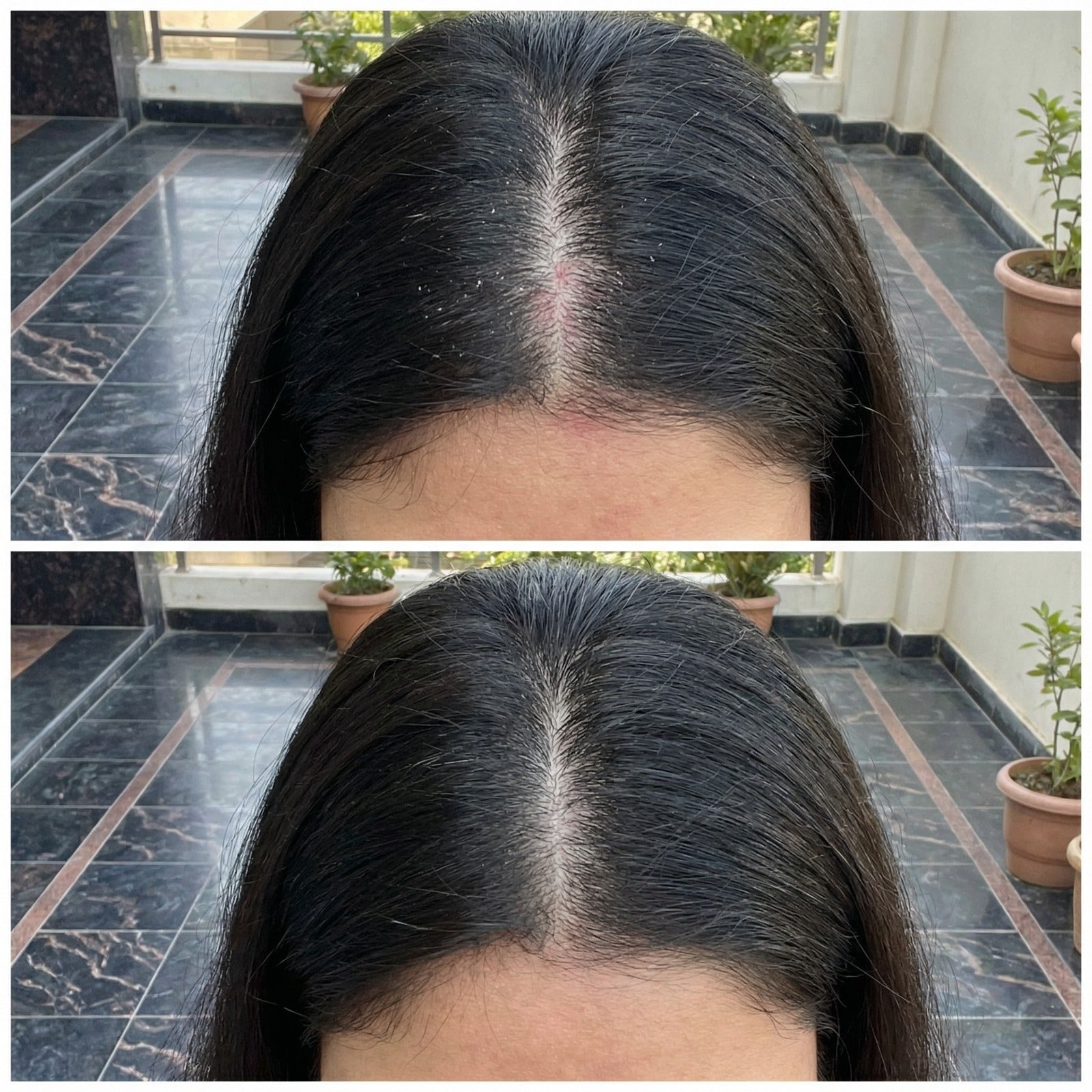 VedicDerm Sensitive Scalp Bundle for Psoriasis, Dandruff, & Itchy Scalp - Distacart