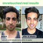 Thumbnail for PLIX The Plant Fix Jamun Active Acne Kit With Spf 50+ Sunscreen & Juicy Cleanser - Distacart