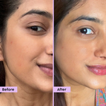 Thumbnail for PLIX The Plant Fix Jamun Active Acne Regime With Cleanser, Toner & Moisturizer For Women & Men - Distacart