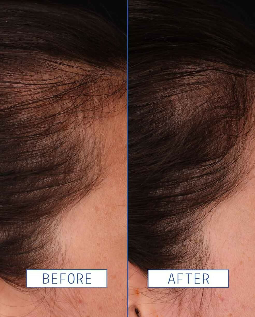 Aavrani Hair Density Boosting Treatment (Serum) - Distacart