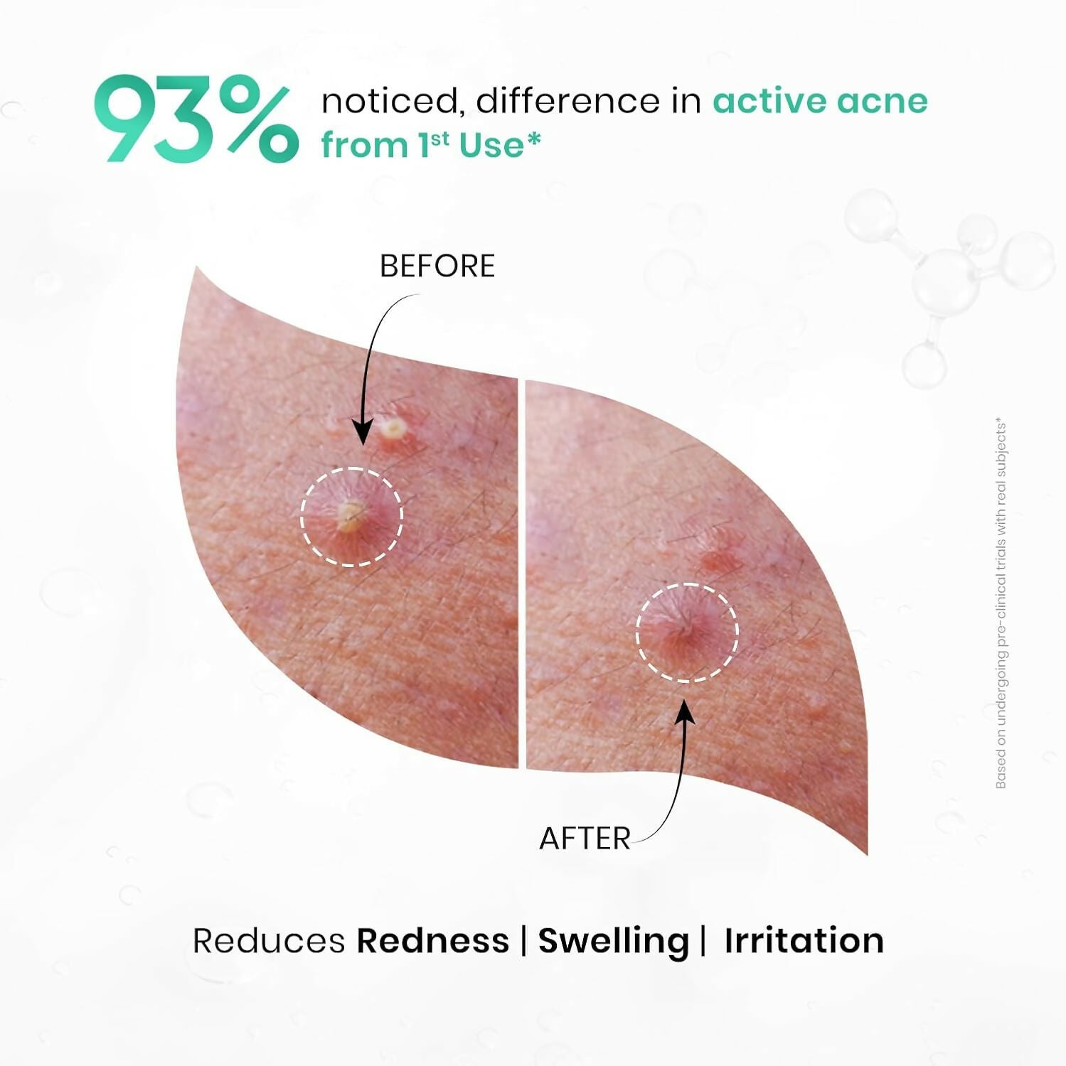 SkinInspired AcNil3 Rapid Spot Corrector - Distacart