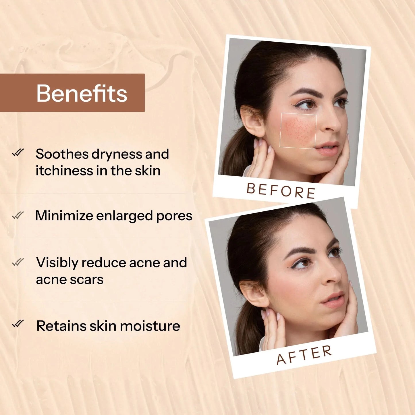 Glopetra Acne Scars & Pits Removal Gel - Dista