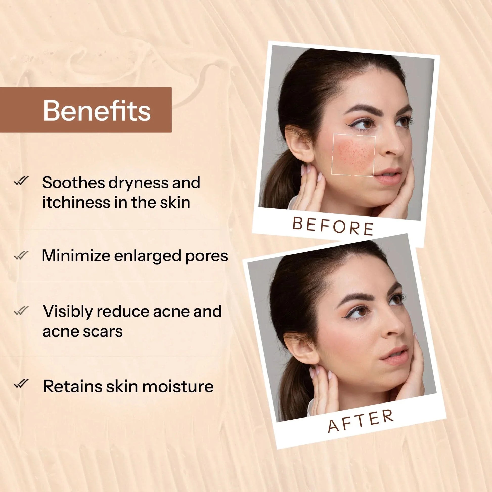 Glopetra Acne Scars & Pits Removal Gel - Dista
