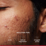 Thumbnail for Proven Honest Derma (PHD) 2% Salicylic Acid Anti-Acne Serum - Distacart
