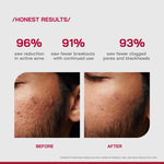 Thumbnail for Proven Honest Derma (PHD) 2% Salicylic Acid Anti-Acne Serum - Distacart