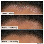 Thumbnail for VedicDerm Plasma Bamboo Charcoal Shampoo for Psoriasis & Sensitive Scalp - Distacart