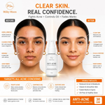 Thumbnail for Milky Moon Rapid Relief Anti-Acne Gel - Dista