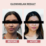 Thumbnail for Dr.Sakhiya Glowmelan Brightening & Depigmentation Gel Cream - Distacart