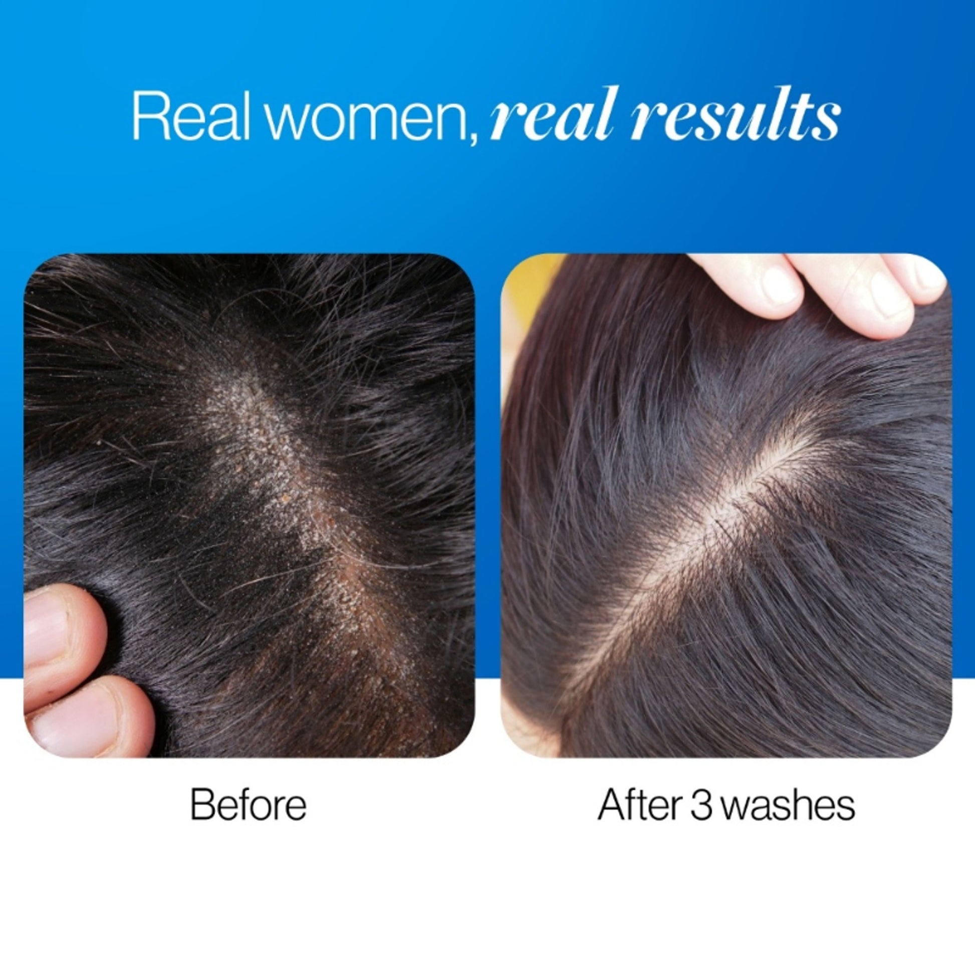 BeBodywise ZPTO Anti Dandruff Shampoo - Reduces Dandruff, Flaking & Deeply Hydrates Scalp - Dista