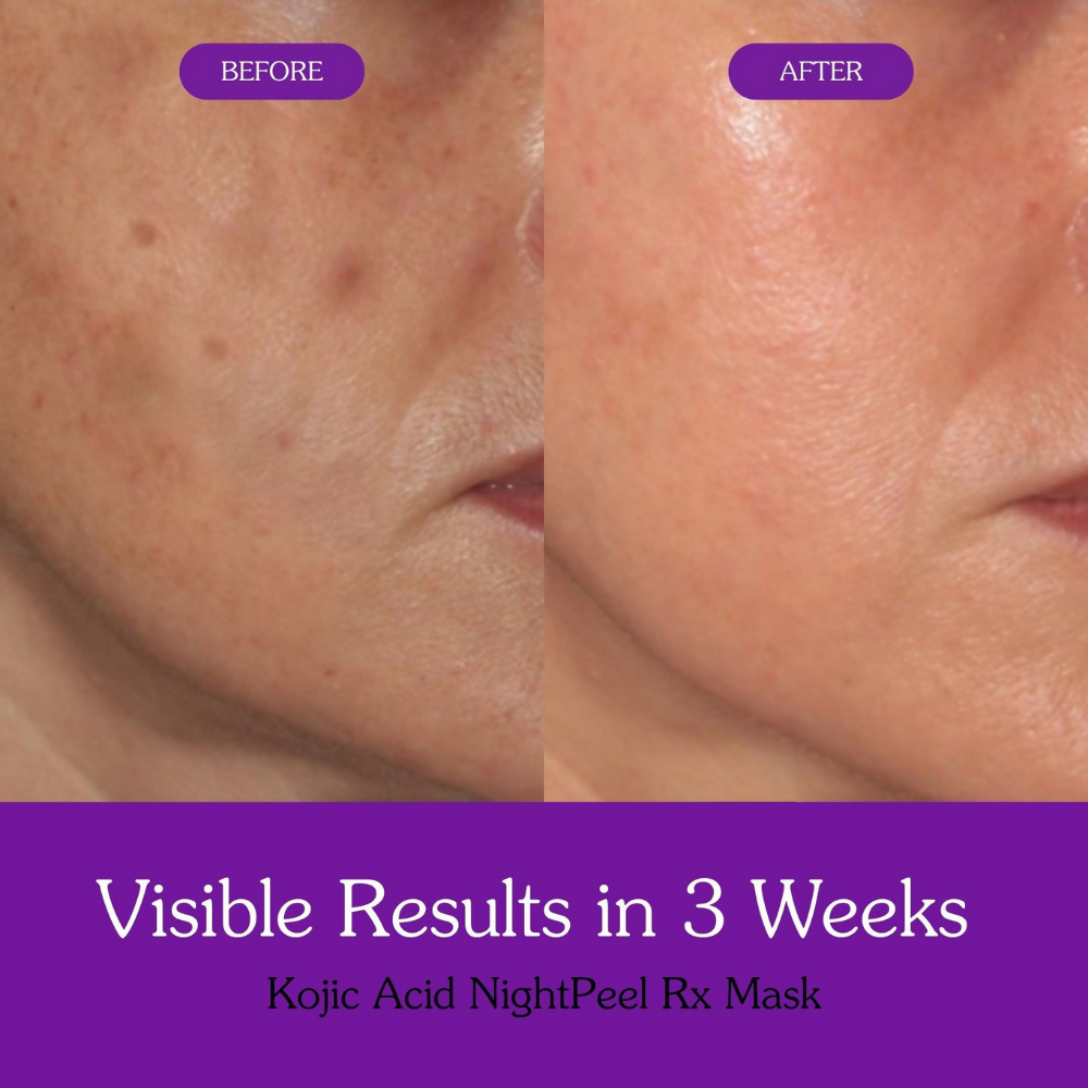 Bake Kojic Acid + Turmeric NightPeel Rx Mask