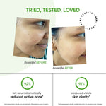 Thumbnail for Dot & Key 2% Salicylic + Zinc Acne Busting Face Serum For Acne & Oil Control - Distacart