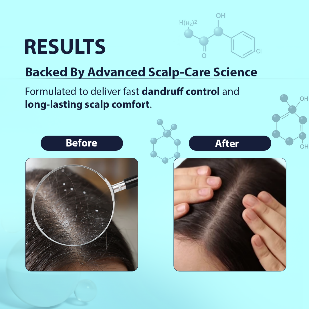 Dermistry Anti-Dandruff Control Hair Serum & Shampoo - Distacart