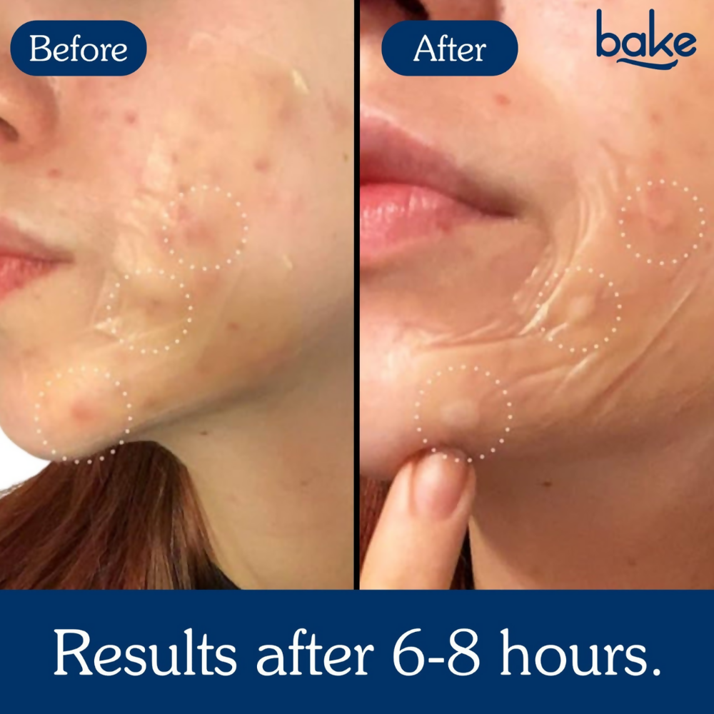 Bake Acne Erase XL Pimple Patches