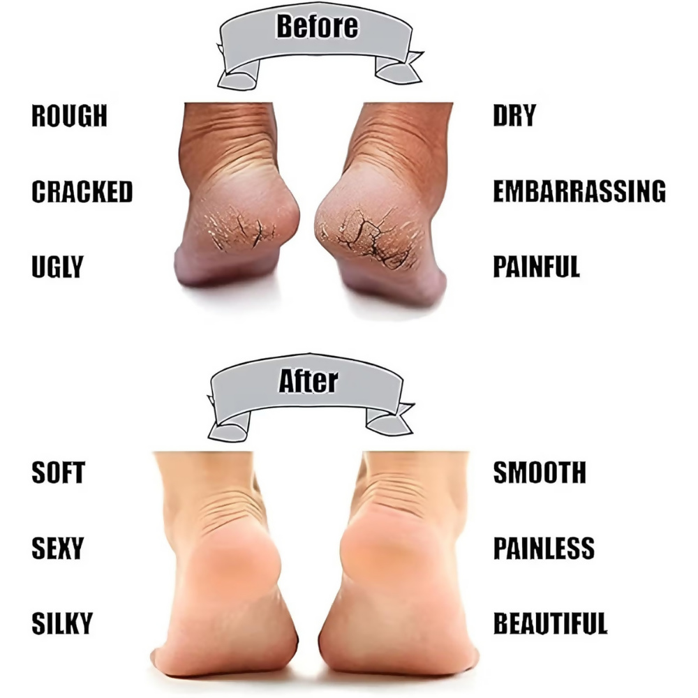Bronson Professional Smiling Foot Anti Crack Silicone Socks - Dista