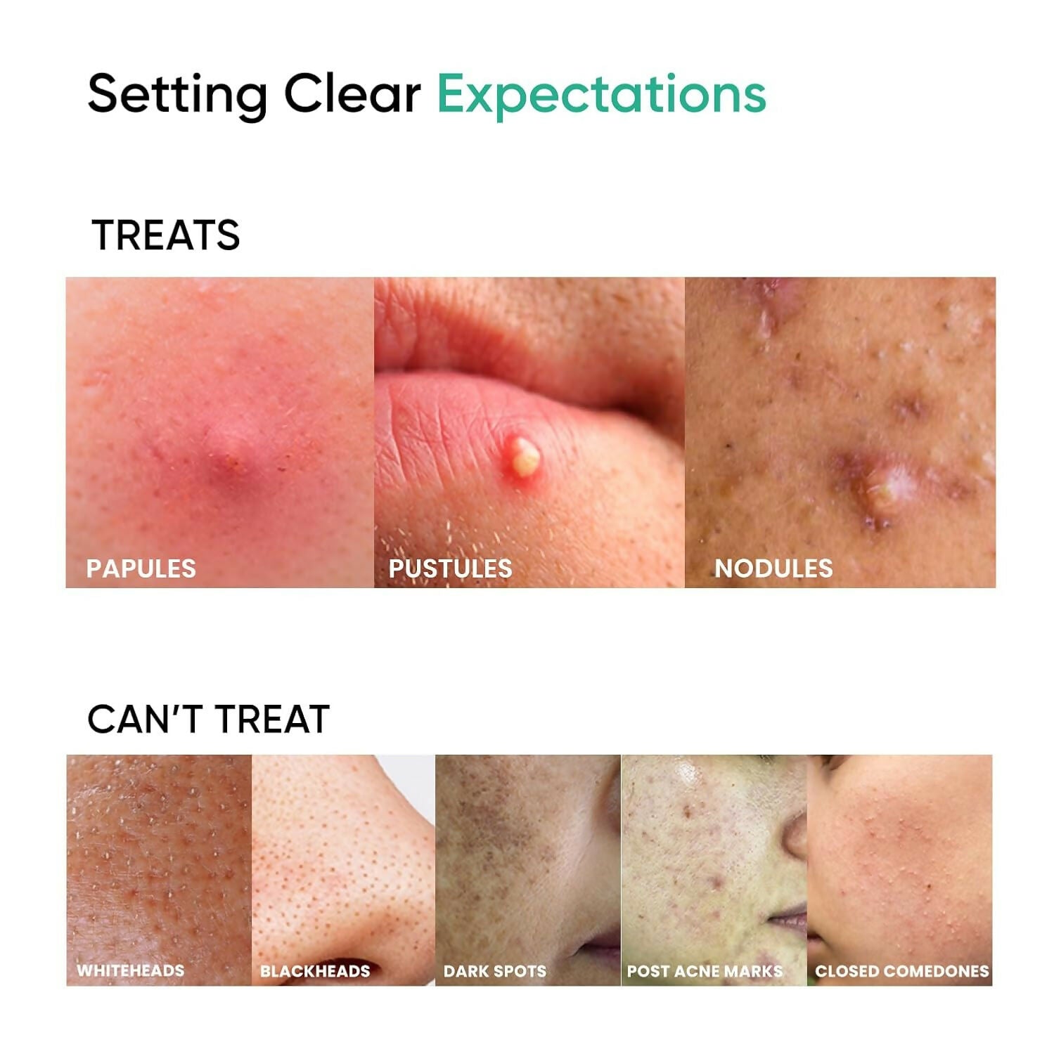 SkinInspired AcNil3 Rapid Spot Corrector - Distacart