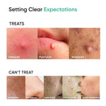 Thumbnail for SkinInspired AcNil3 Rapid Spot Corrector