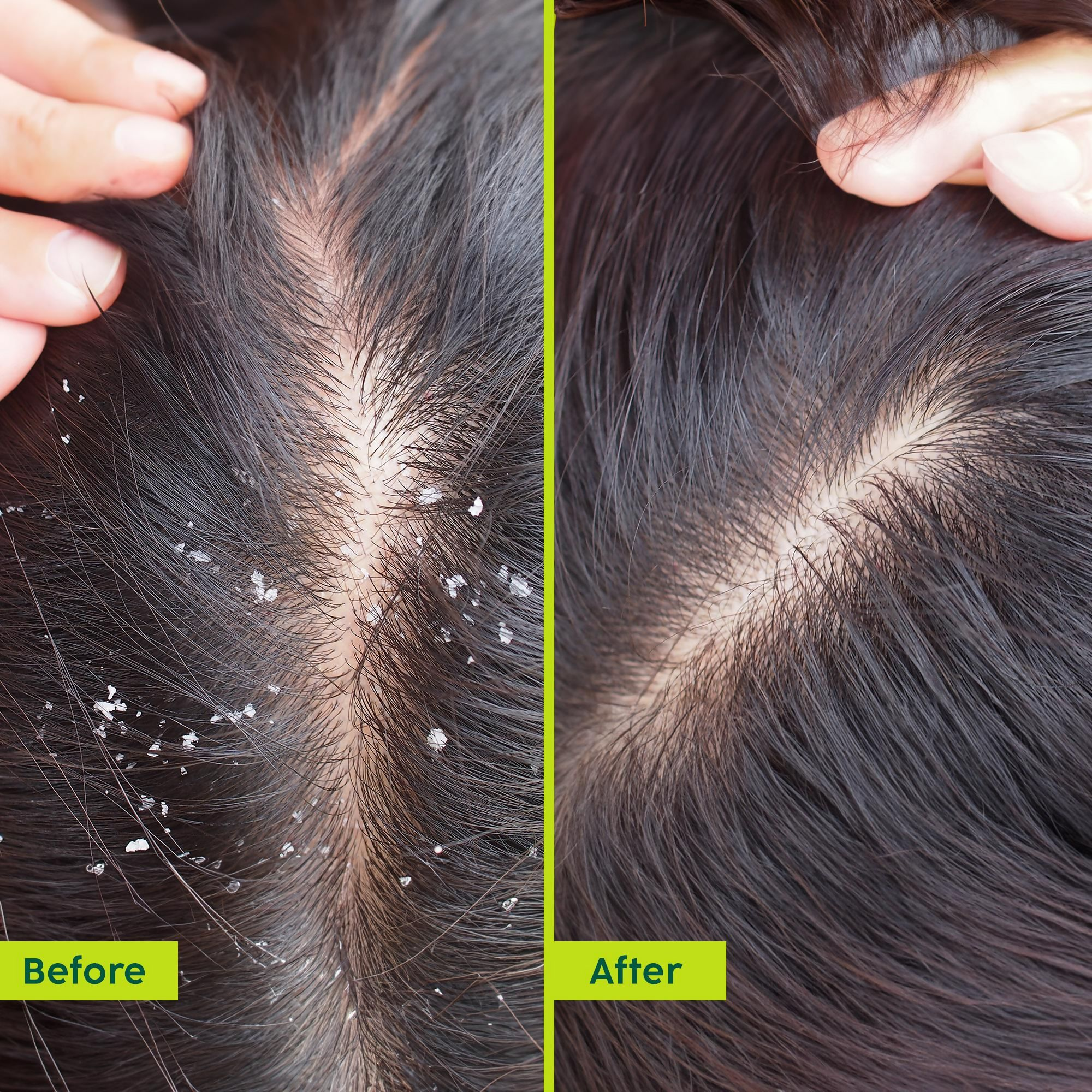 PLIX The Plant Fix Neem Anti-Dandruff Advanced Hair Serum For Reduce Dandruff & Inflammation - Distacart