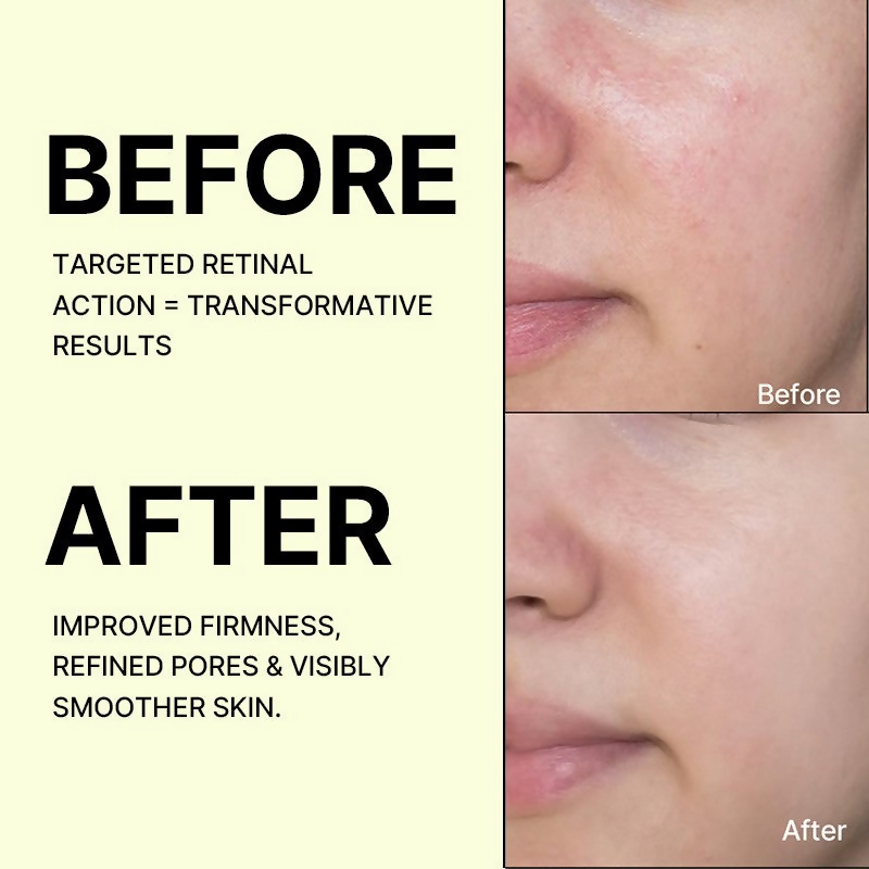 Celimax The Vita-A Retinal Shot Tightening Booster For Anti-Aging, Dark Spots & Wrinkles - Distacart