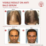 Thumbnail for Ivory Natural Bald Serum For Baldness, Hair Thinning And Hair Fall - Distacart