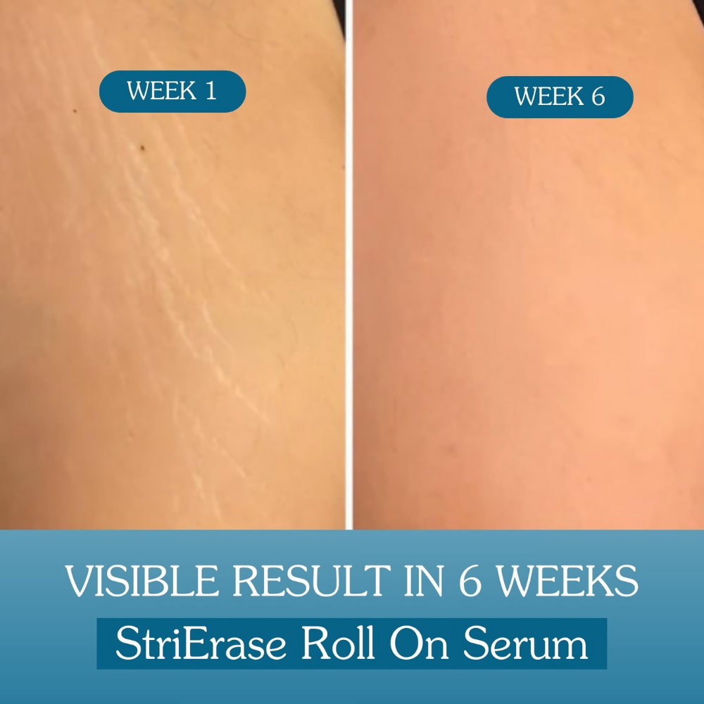 Bake StriErase™ Stretch Marks Removal Roll-On Serum - Distacart