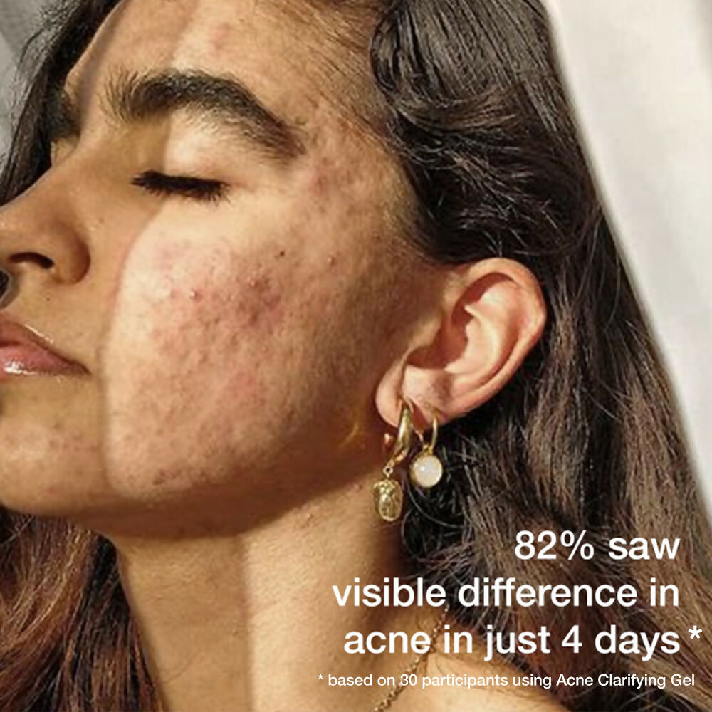 Skog Acne Clarifying Gel