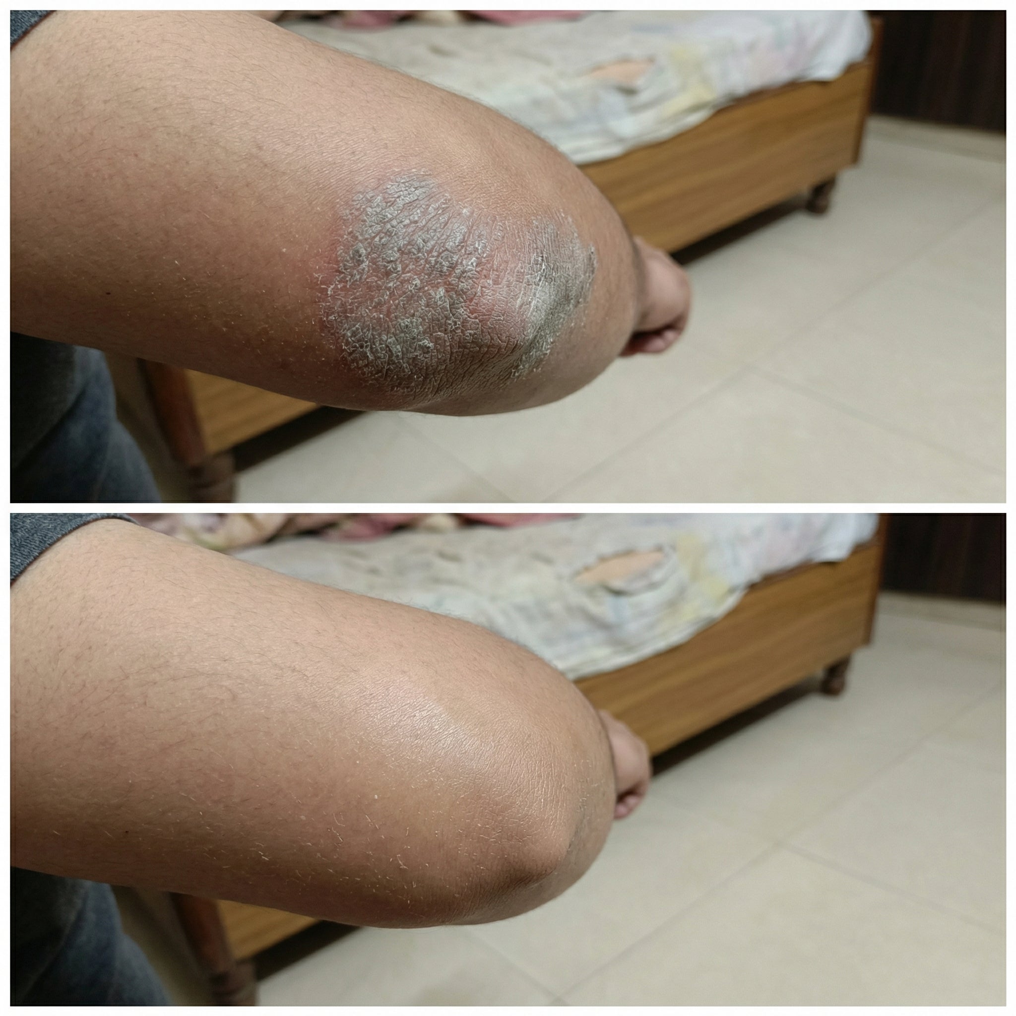 Vedicderm Psoriasis Cream - Distacart