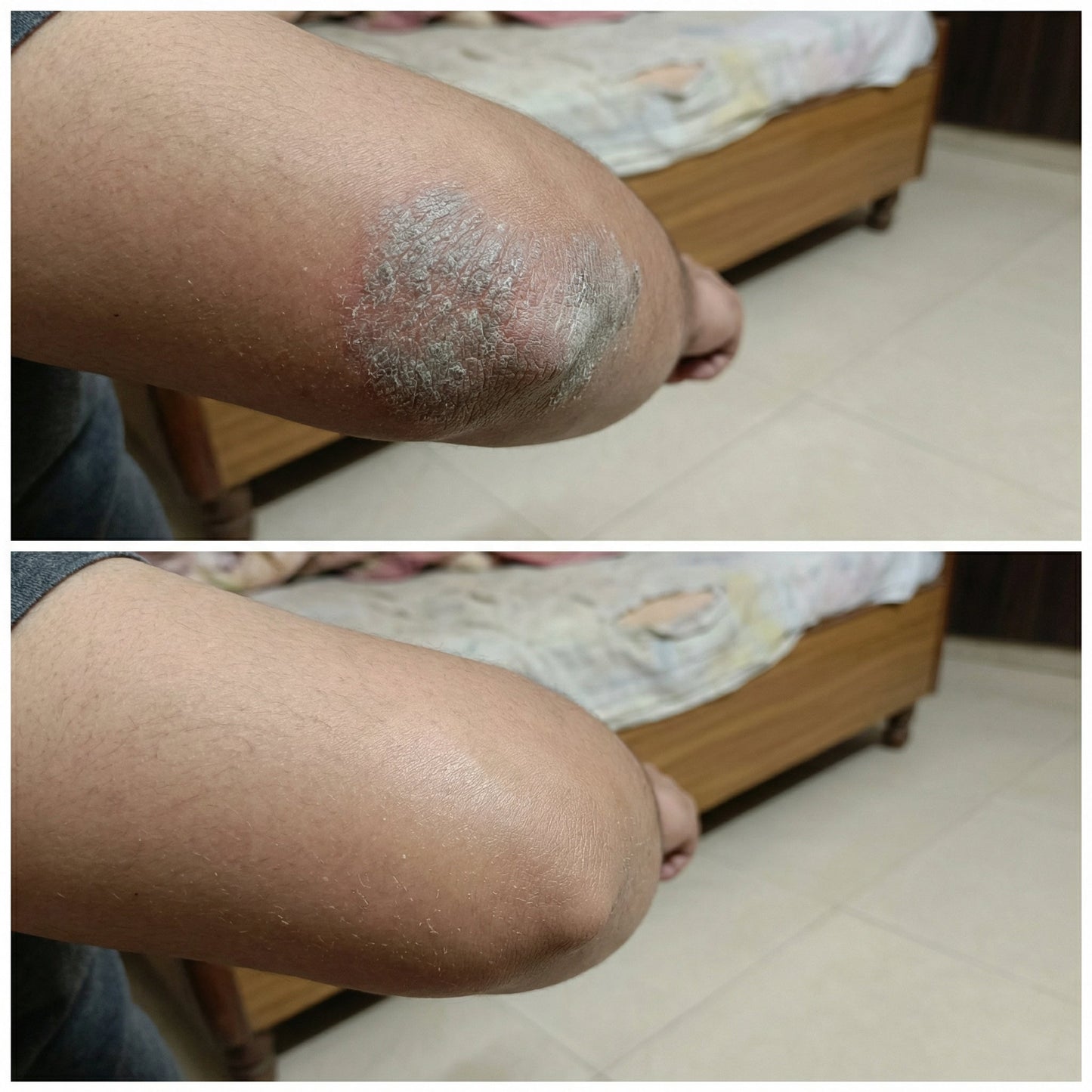 Vedicderm Psoriasis Cream - Distacart