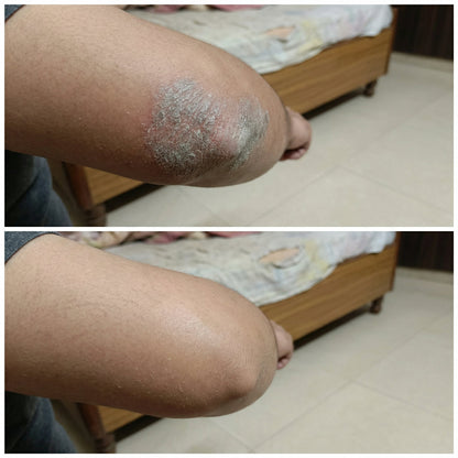 Vedicderm Psoriasis Cream - Distacart