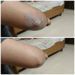 Thumbnail for Vedicderm Psoriasis Cream - Distacart