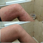 Thumbnail for Vedicderm Psoriasis Cream - Distacart